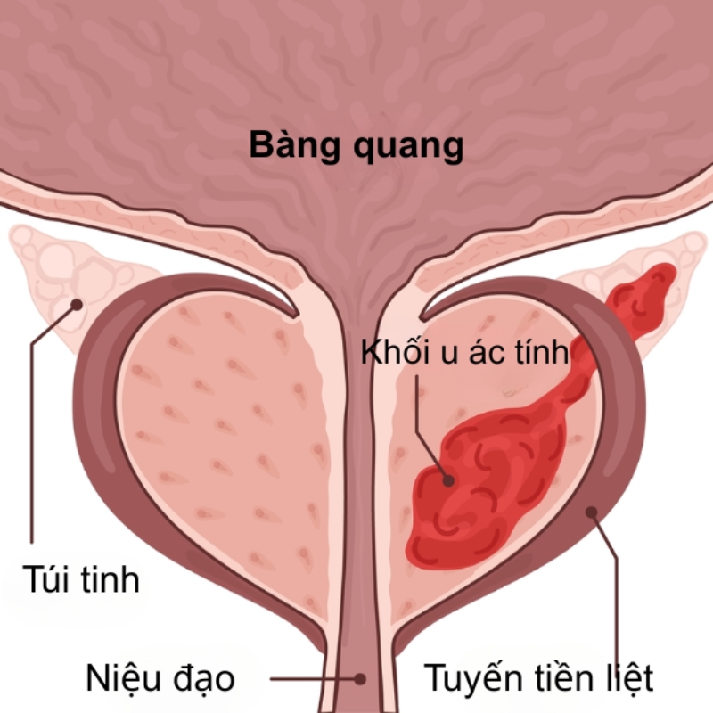 ung thư giai đoạn 3