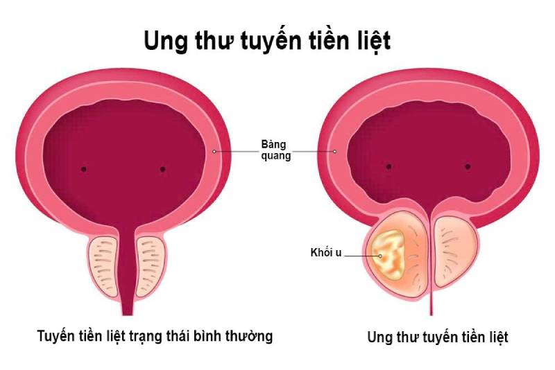 ung thư giai đoạn đầu