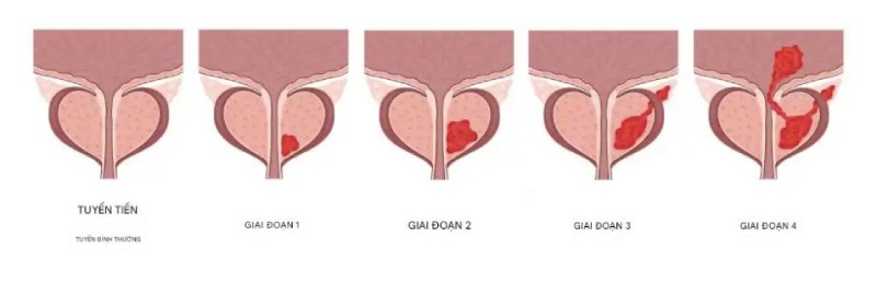 Ung thư tuyến tiền liệt giai đoạn 2 còn khu trú, tiên lượng tốt