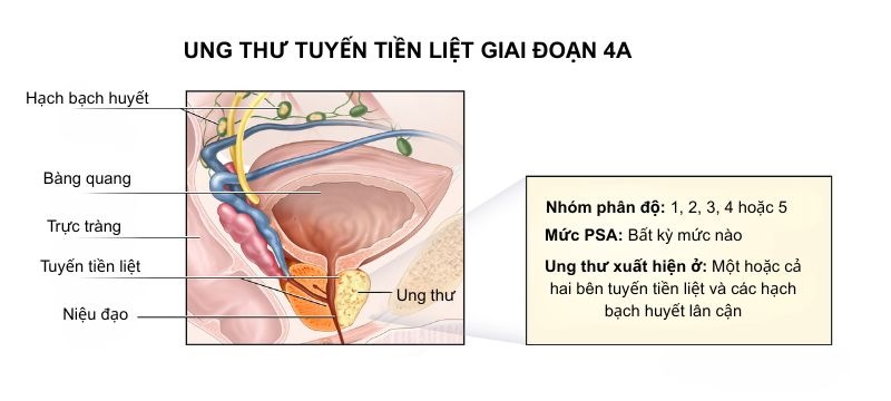 Ung thư tuyến tiền liệt giai đoạn 4A di căn hạch và mô lân cận
