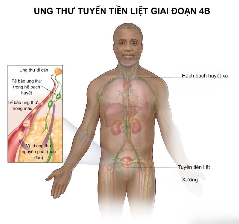 Ung thư tuyến tiền liệt giai đoạn 4B di căn cơ quan xa