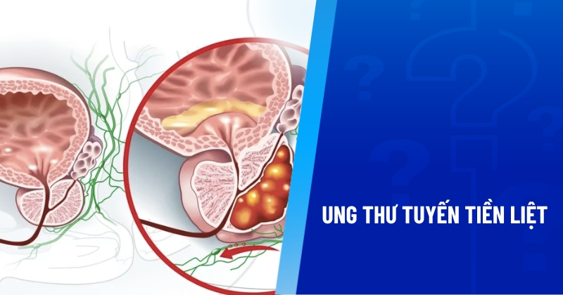 ung thư tuyến tiền liệt