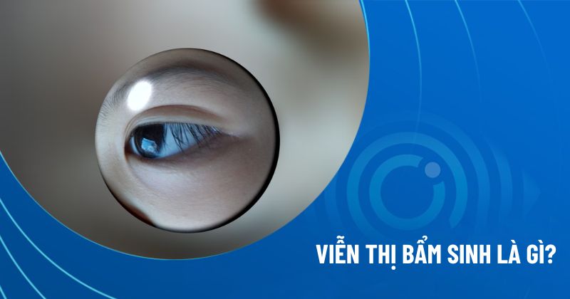 viễn thị bẩm sinh