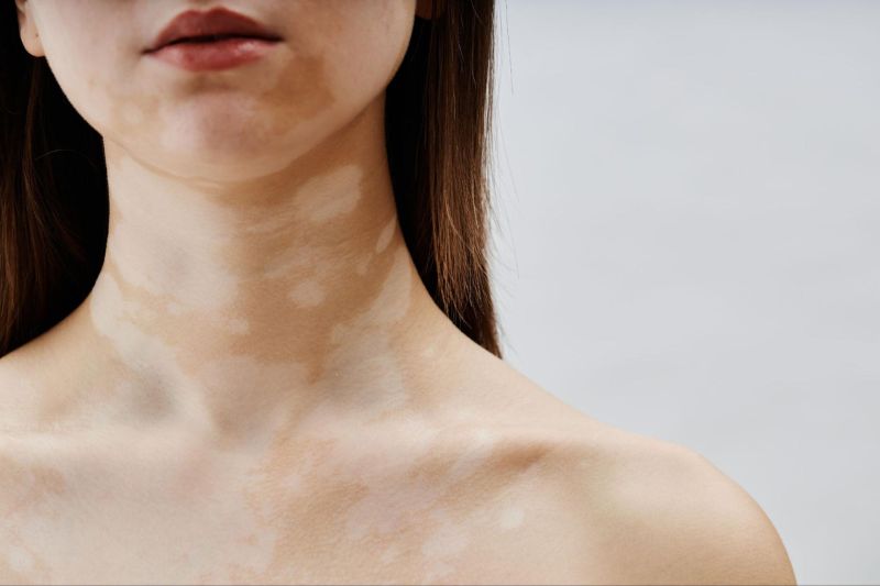 da bị giảm sắc tố