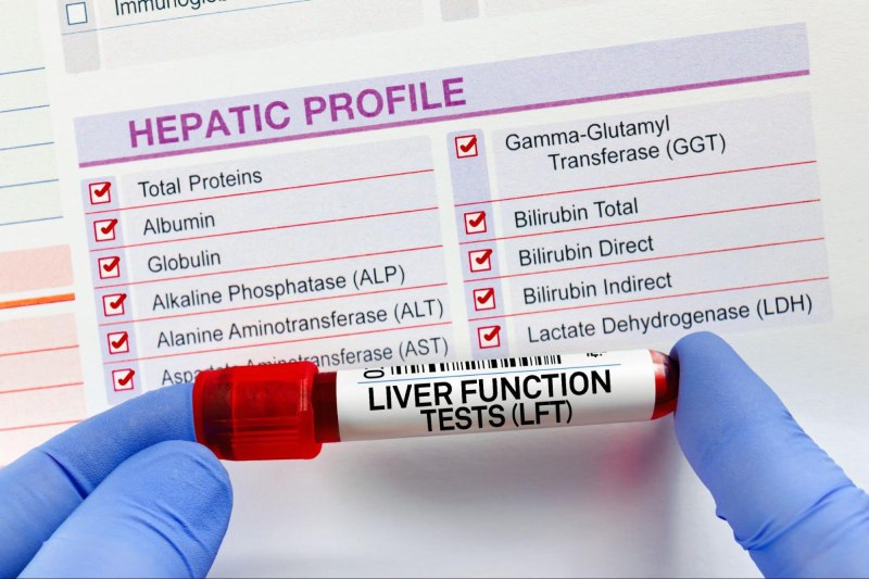 Xét nghiệm men gan có thể cần nhịn ăn theo chỉ định bác sĩ