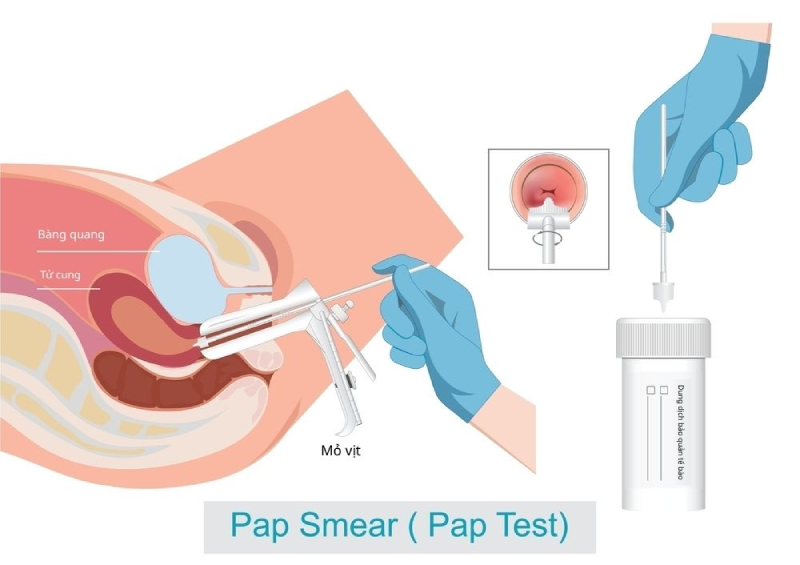 xét nghiệm pap smear