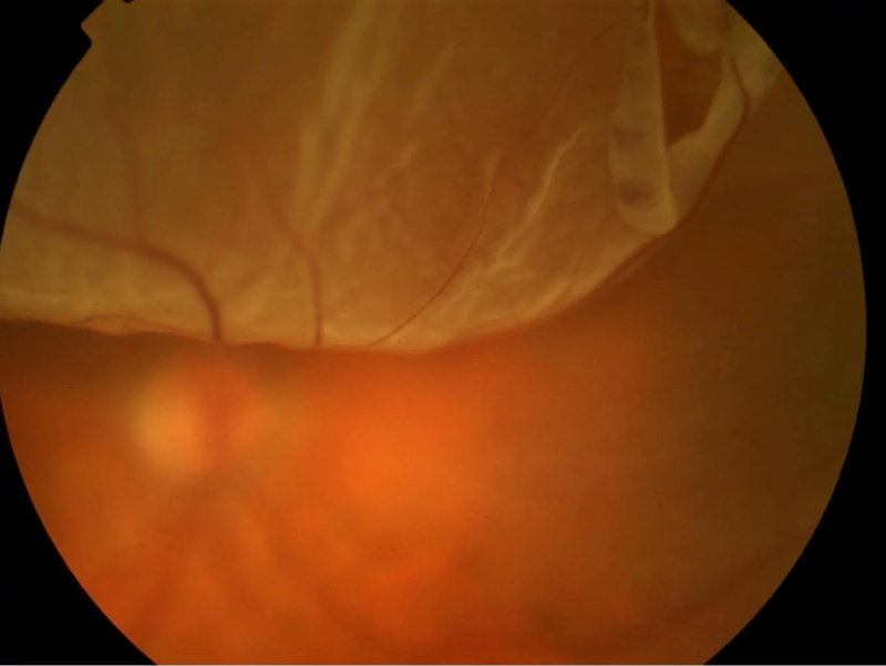 ảnh chụp đáy mắt bị bong võng mạc