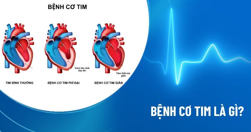 bệnh cơ tim