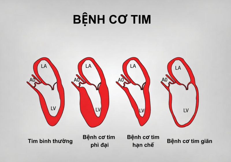 các loại bệnh cơ tim