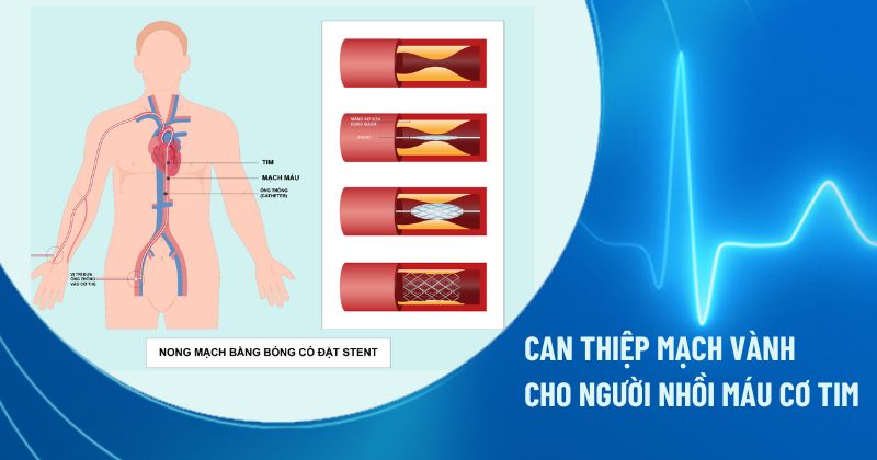 can thiệp mạch vành cho người nhồi máu cơ tim
