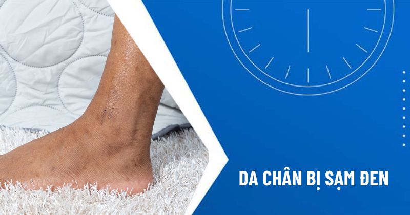 da chân bị sạm đen