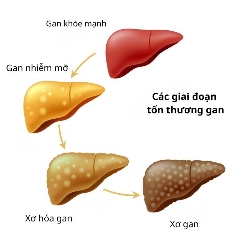 giai đoạn tổn thương gan
