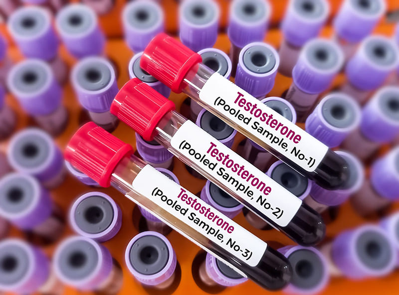 nên xét nghiệm testosterone định kỳ