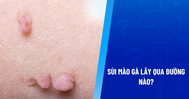 sùi mào gà lây qua đường nào