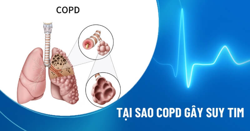 Giải thích tại sao COPD gây suy tim phải?