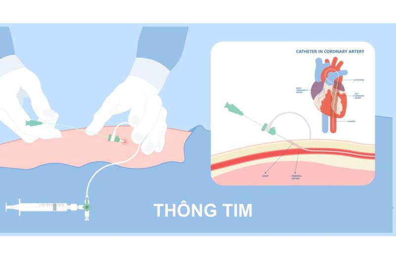 thủ thuật thông tim