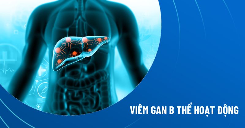 viêm gan B thể hoạt động