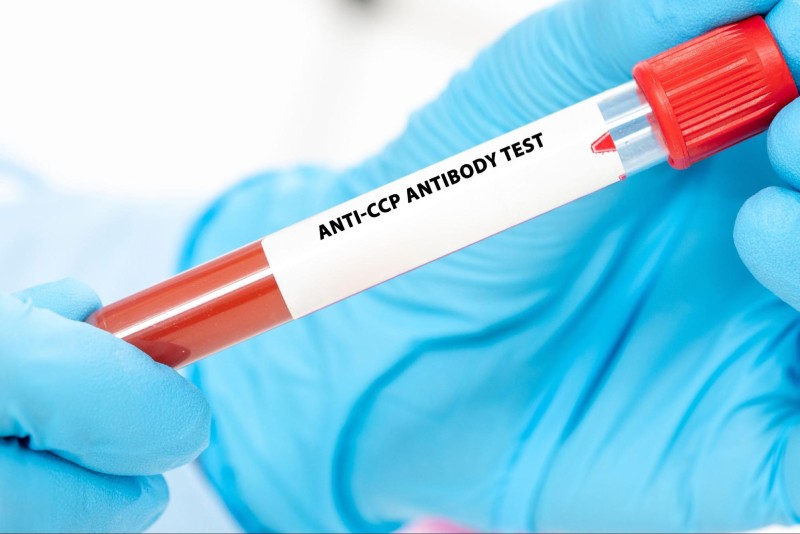xét nghiệm kháng thể Anti-CCP