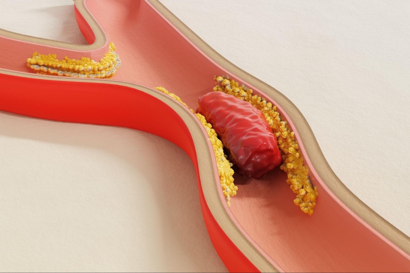 xơ vữa động mạch gây nhồi máu