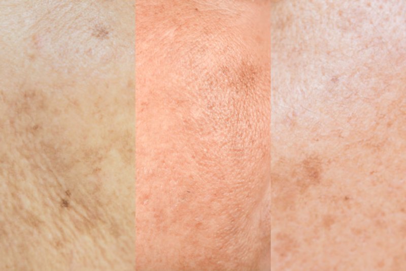 da sẫm màu do tế bào chết