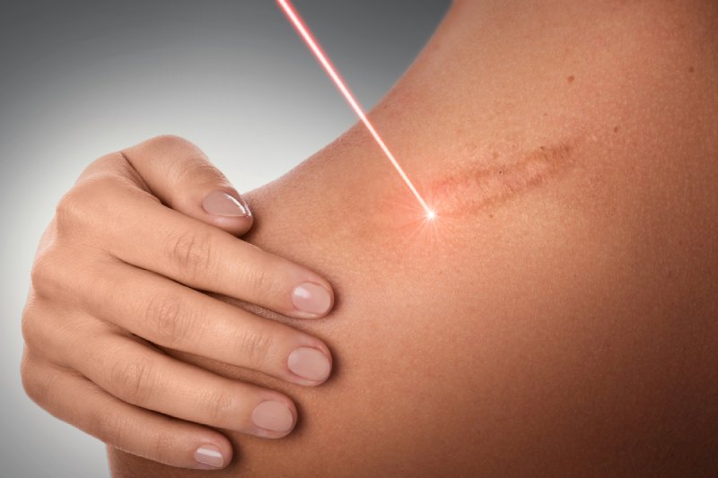 laser làm mờ sẹo