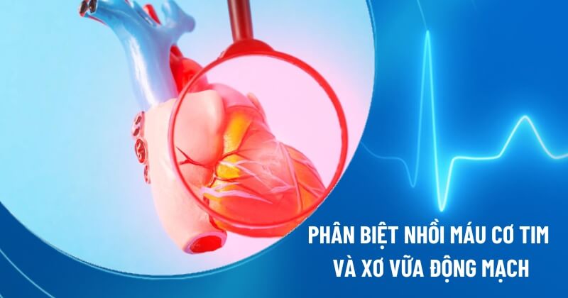 nhồi máu cơ tim và xơ vữa động mạch