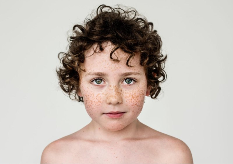 tàn nhang ở trẻ em