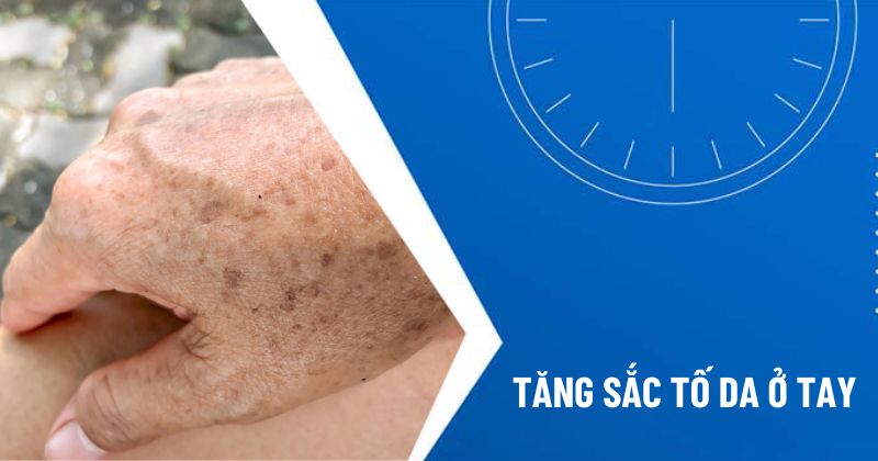 tăng sắc tố da ở tay