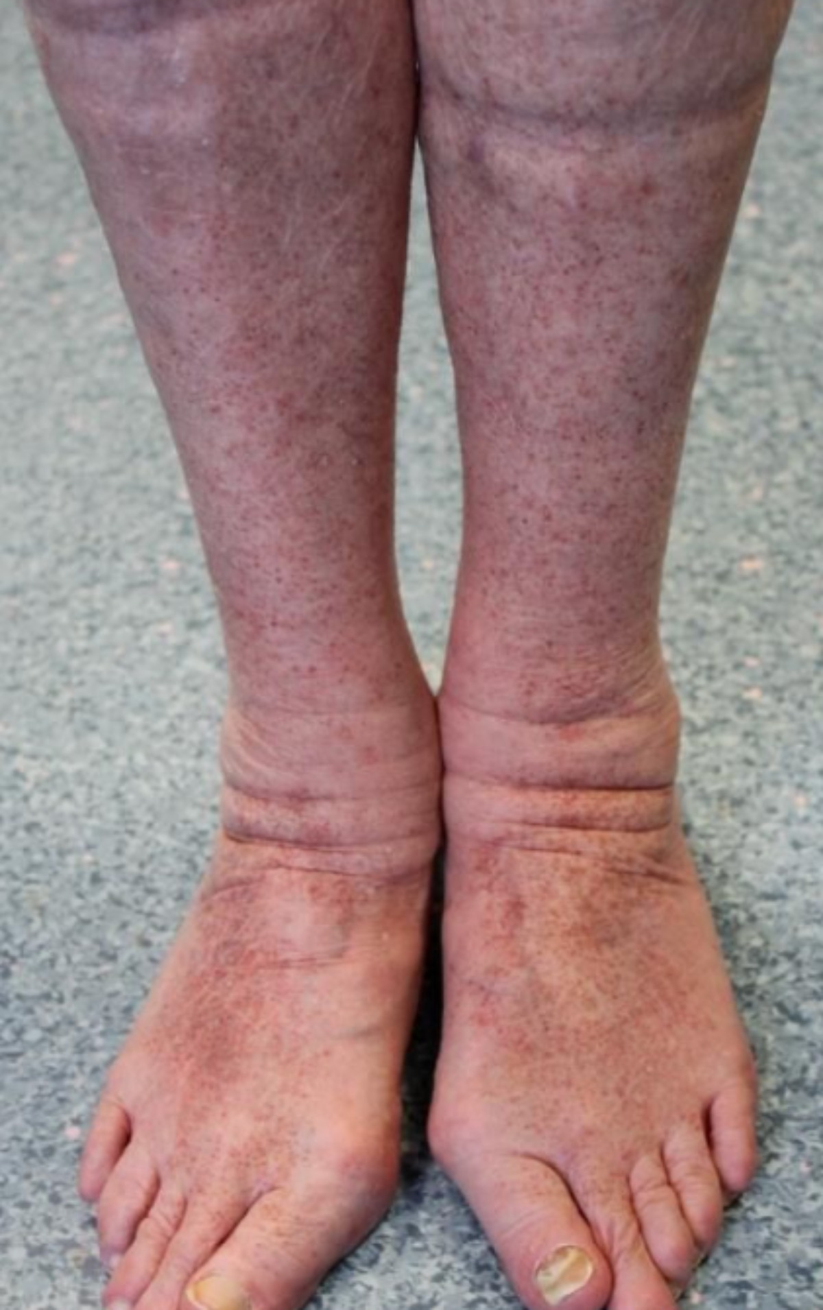 ban xuất huyết ngứa