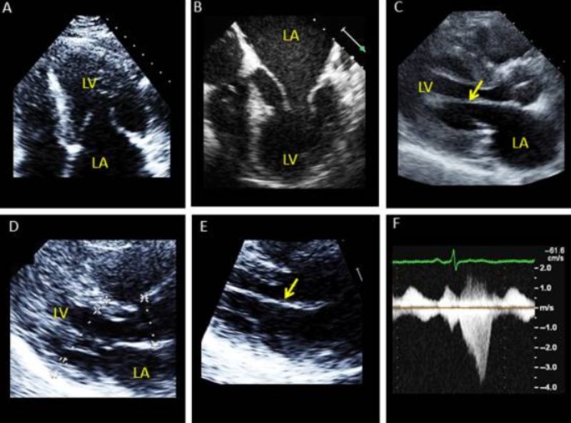 bất thường của bộ máy van hai lá