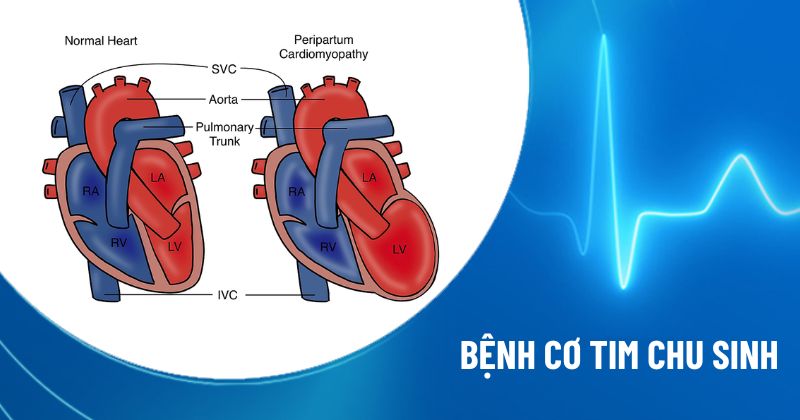 bệnh cơ tim chu sinh