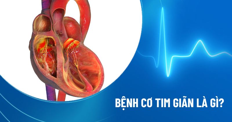 bệnh cơ tim giãn