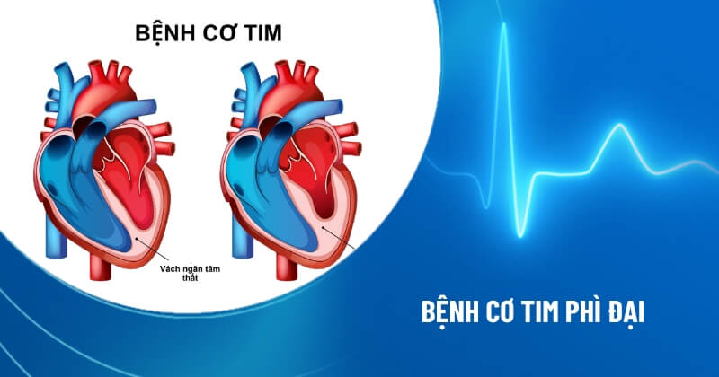 bệnh cơ tim phì đại