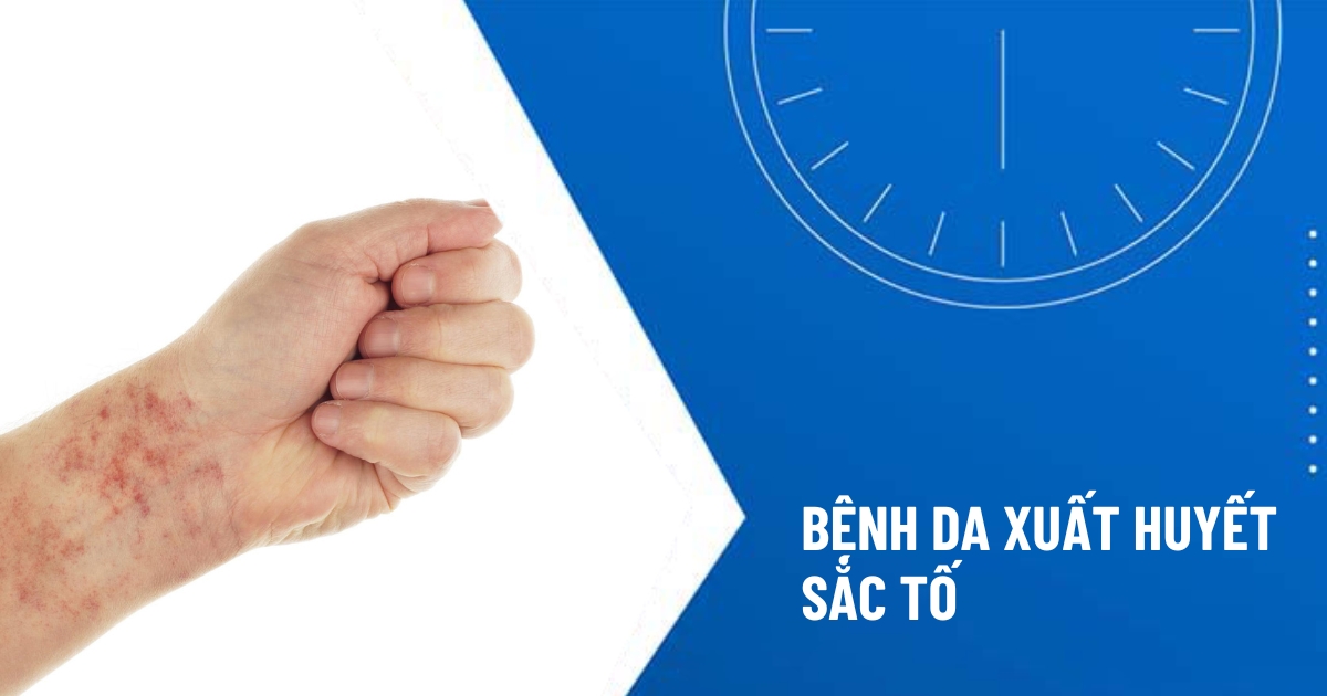 bệnh da xuất huyết tăng sắc tố