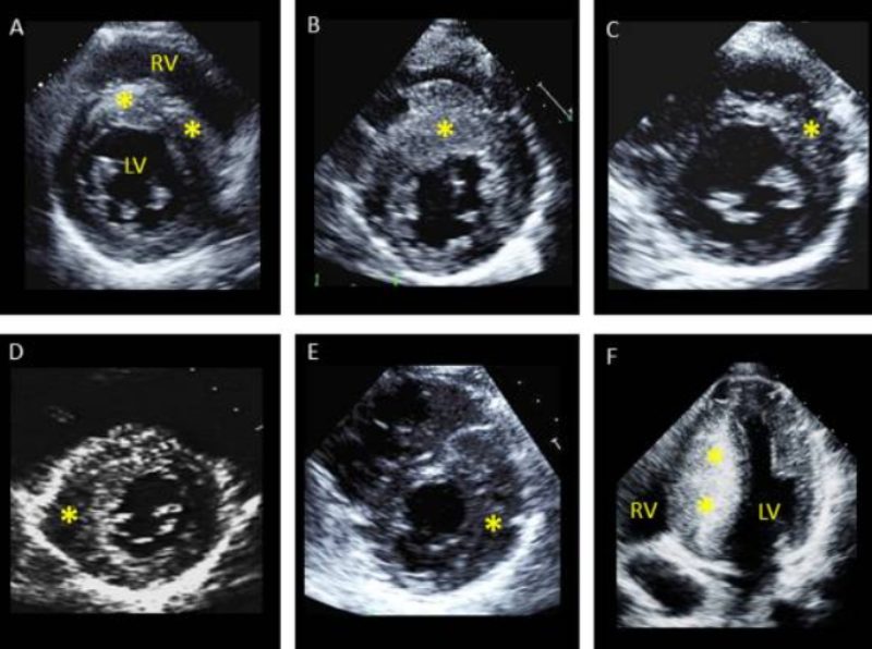 các dạng phì đại thất trái