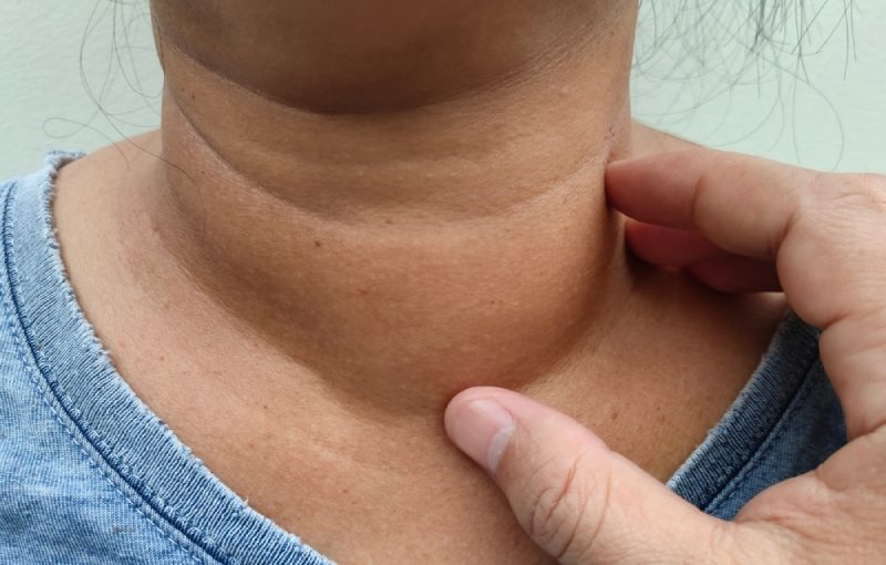 cổ sưng và sạm đen