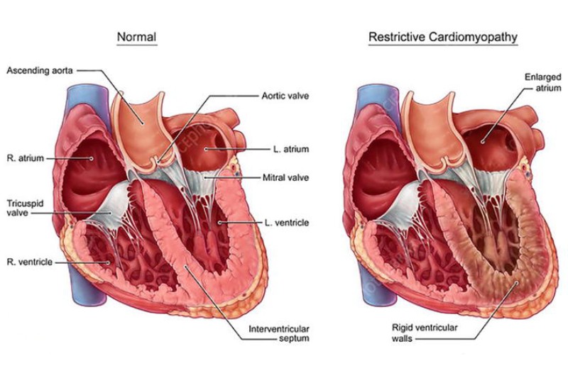 cơ tim hạn chế là gì