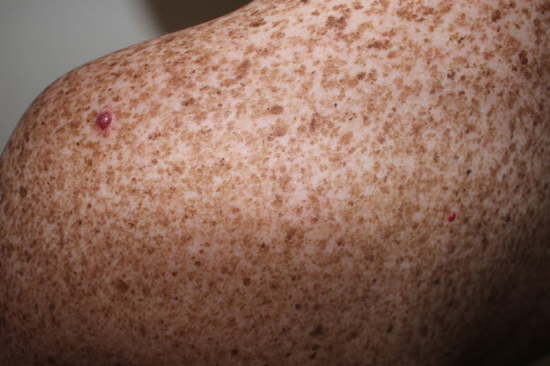 da bị khô da sắc tố