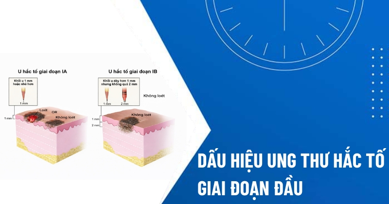 dấu hiệu ung thư hắc tố giai đoạn đầu