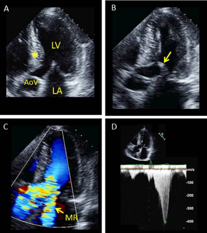 hình ảnh bệnh cơ tim phì đại siêu âm