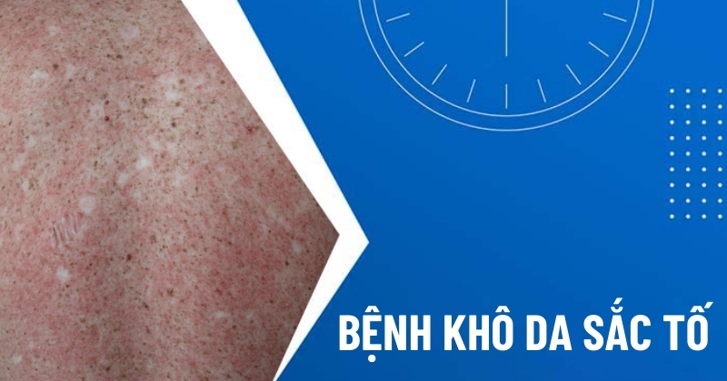 khô da sắc tố