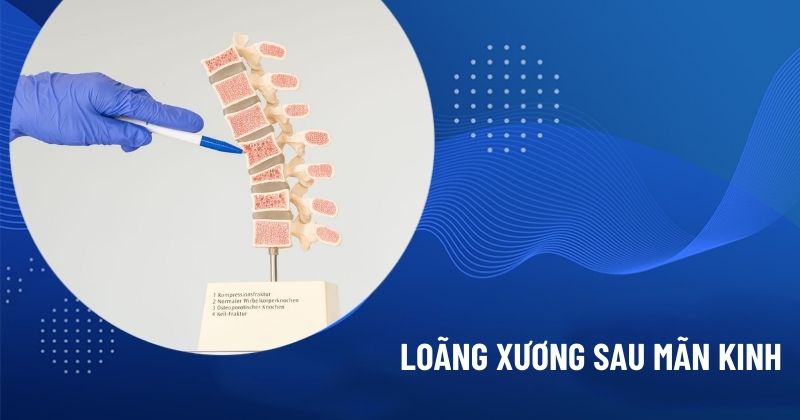 loãng xương sau mãn kinh