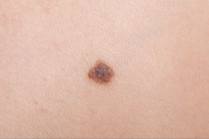 nốt ruồi sần hơi gồ