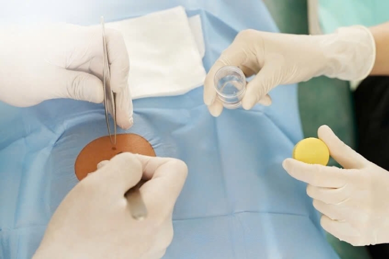 phẫu thuật cắt bỏ khối u