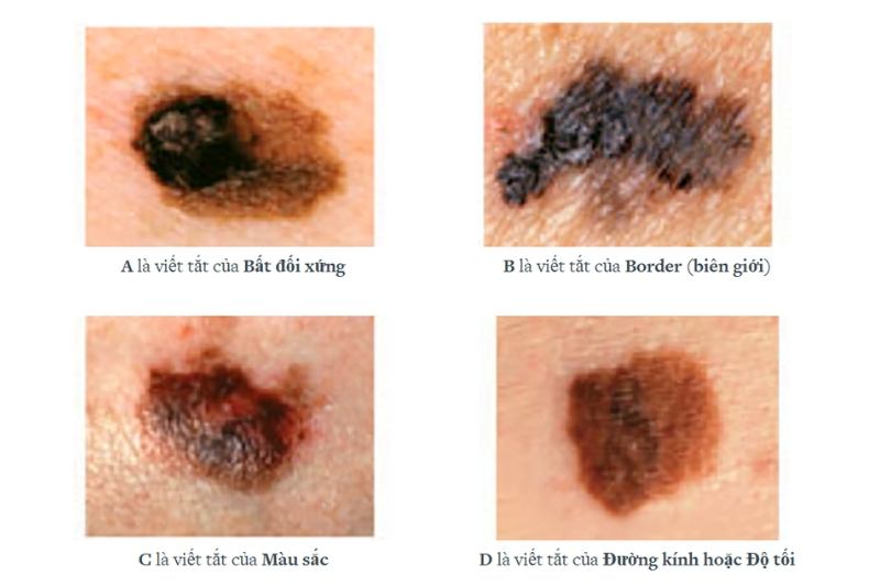 quy tắc abcde phát hiện u hắc tố giai đoạn 1