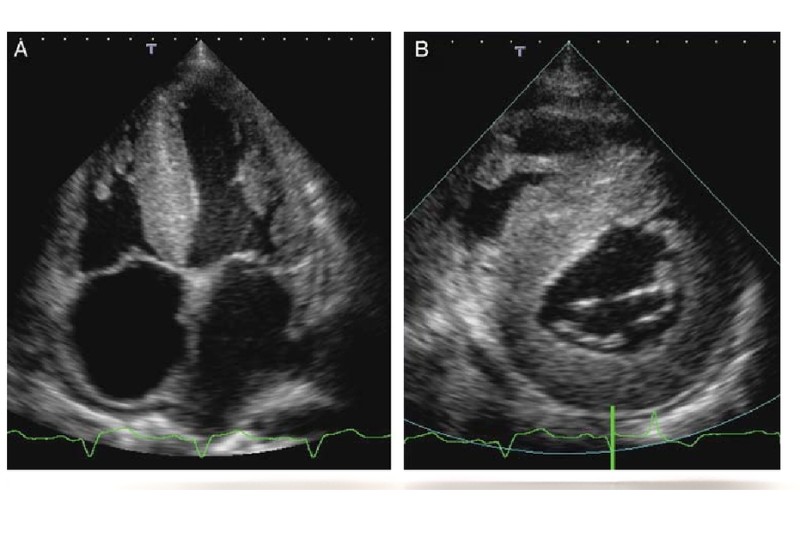 siêu âm tim phát hiện cơ tim hạn chế