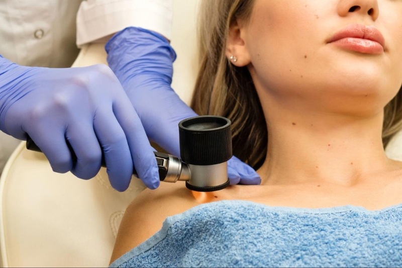 soi da phát hiện u hắc tố da