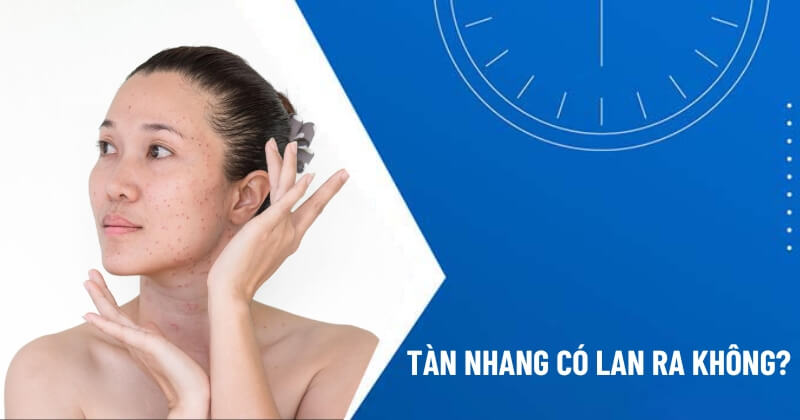 tàn nhang có lan ra không