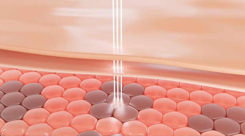 tia laser điều trị tàn nhang