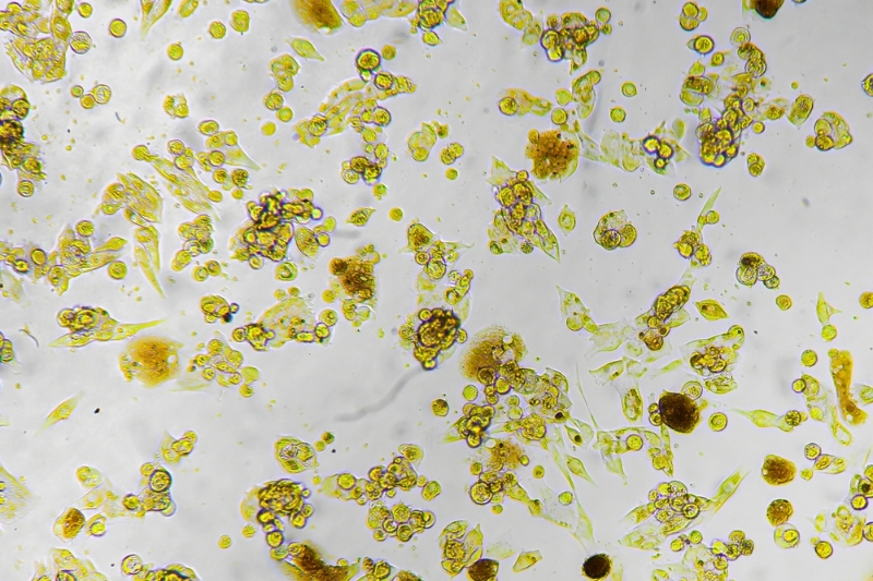 u hắc tố da có thể chữa khỏi nếu chưa di căn xa